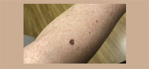 melanoma in situ nachsorge